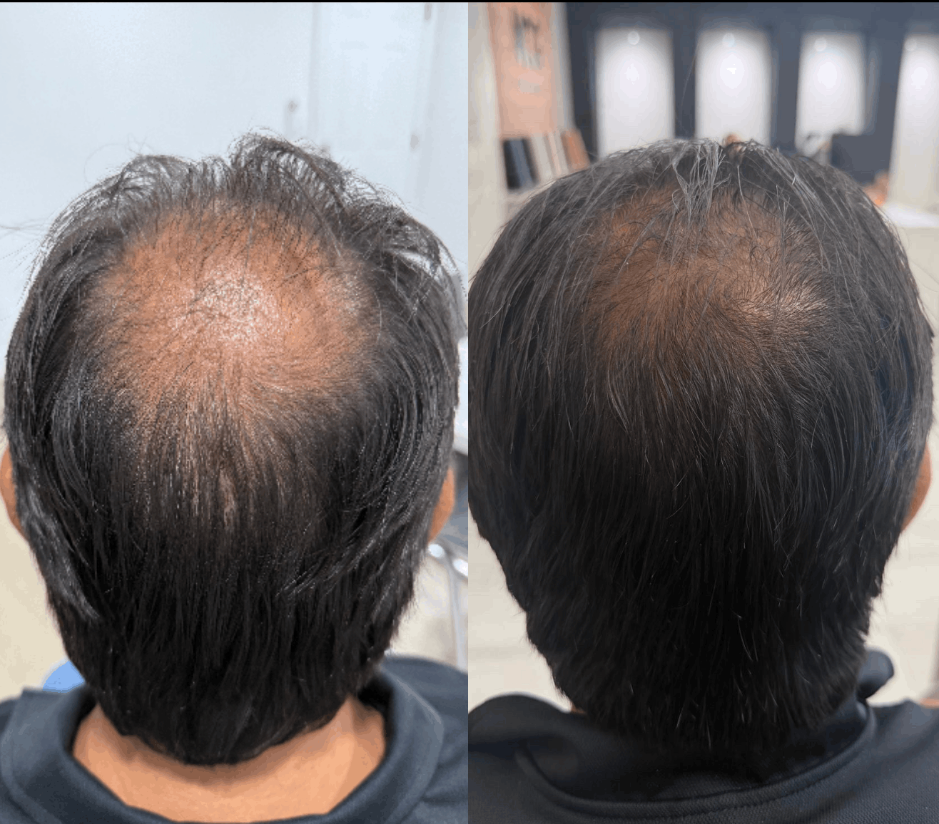 Comparativo do vértice do couro cabeludo de um paciente do sexo masculino, antes e durante o acompanhamento.